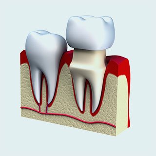 Dental Crown